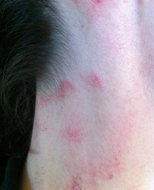 Kim再次在微博上曝光了一张颈部有多处红肿的家暴照片