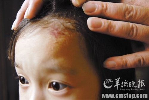电暖袋爆炸烫伤4岁女童。