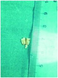 花生碎钻进男童气管险丧命