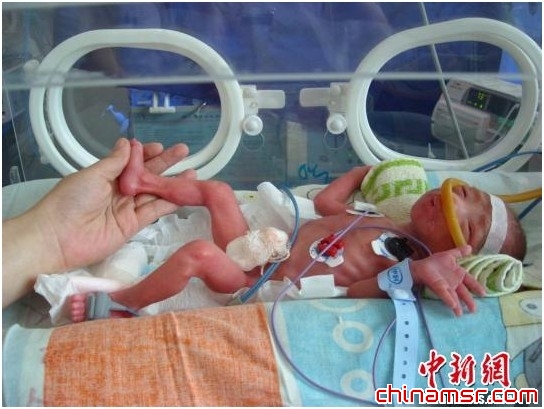 湖北宜昌“袖珍女婴”顽强存活