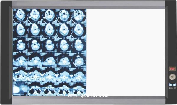 医用超薄液晶观片灯