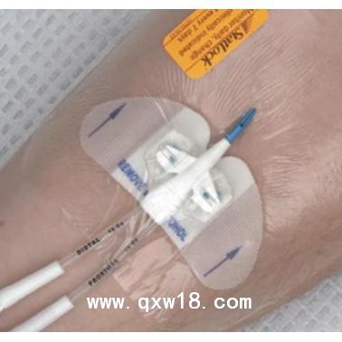 思乐扣导管固定装置