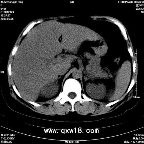 脂肪肝分析检测诊断仪系统