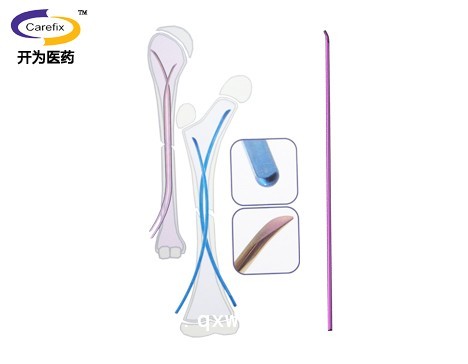上海开为Carefix二代弹性髓内针