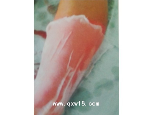 烧伤科人工皮膜