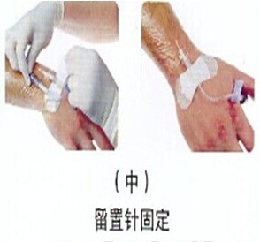 导管固定用敷料