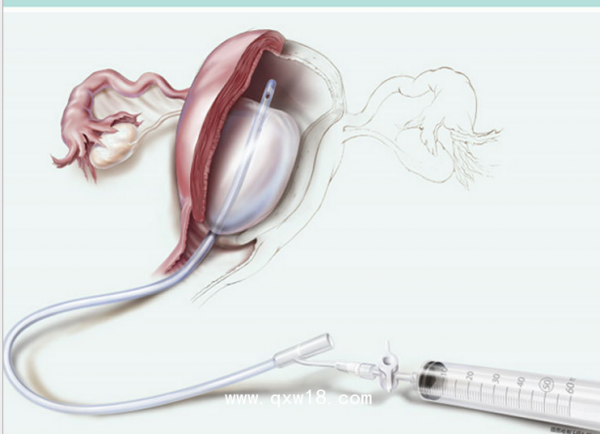 子宫填塞球囊导管J-SOS-100500