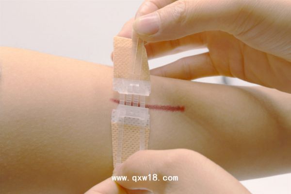 无针皮肤缝合器